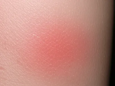 Illustration chafe - Image 1