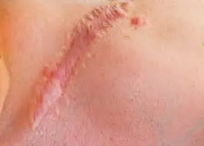 Illustration scar - Image 2