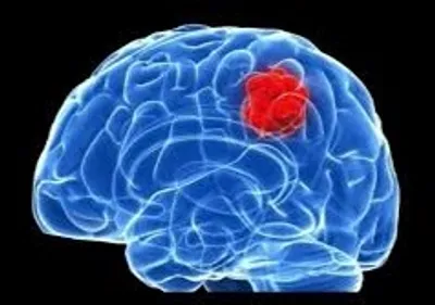 Illustration tumor - Image 2