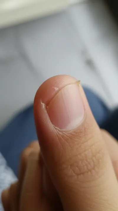Illustration hangnail - Image 1