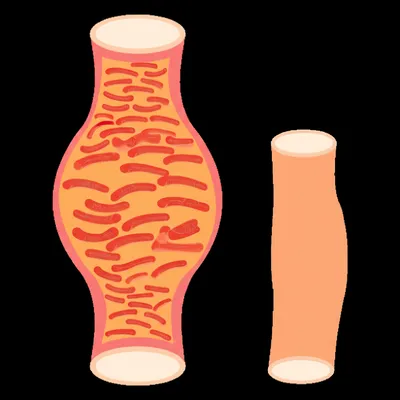 Illustration hypertrophy