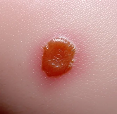 Illustration scab - Image 1