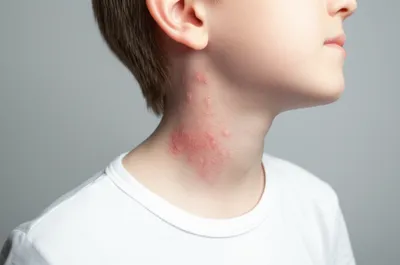 Illustration scrofula - Image 1