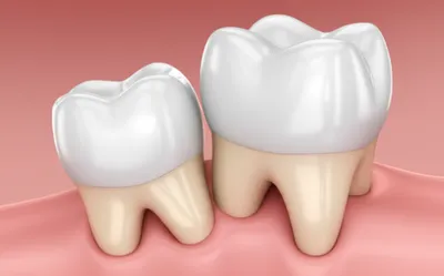 Illustration impaction - Image 1