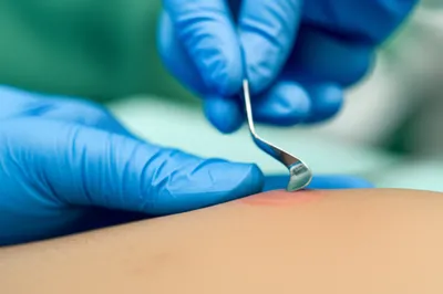 Illustration curette