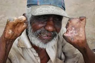 Illustration leprosy - Image 2