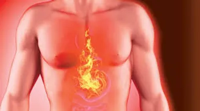 Illustration heartburn - Image 2