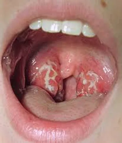 Illustration tonsillitis - Image 2