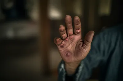 Illustration pox - Image 1