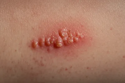 Illustration tetter - Image 1