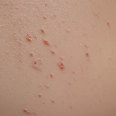 Illustration pockmarks