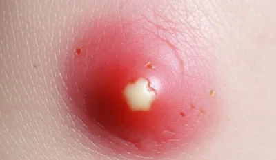 Illustration pimples