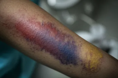 Illustration bruising - Image 1