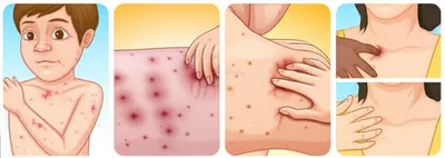 Illustration varicella - Image 1