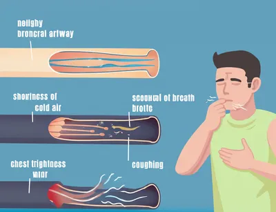 Illustration asthma - Image 1