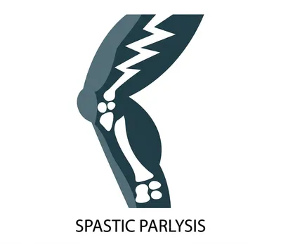 Illustration spastic - Image 1