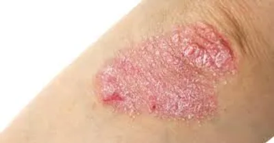 Illustration eczema - Image 2