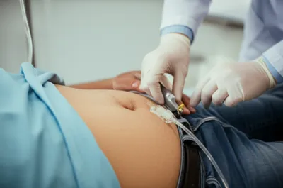 Illustration paracentesis