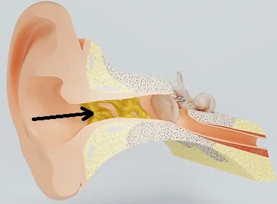 Illustration earwax - Image 2