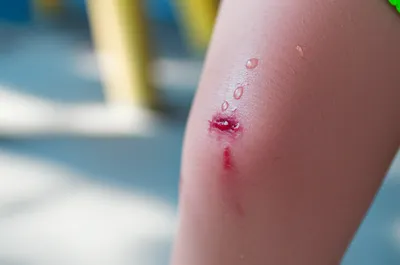 Illustration smarting - Image 1