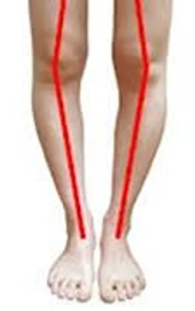 Illustration bowlegged - Image 2
