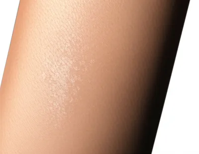 Illustration blotch - Image 1