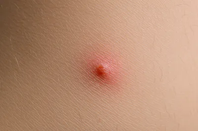 Illustration wheal - Image 1