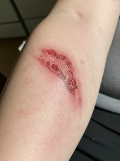 Illustration lacerations