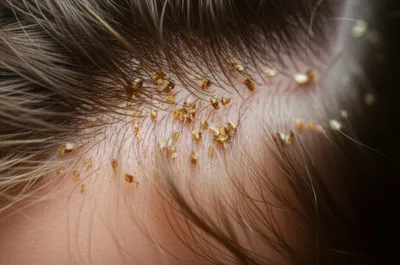 Illustration lousy - Image 1