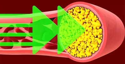 Illustration atherogenic - Image 1