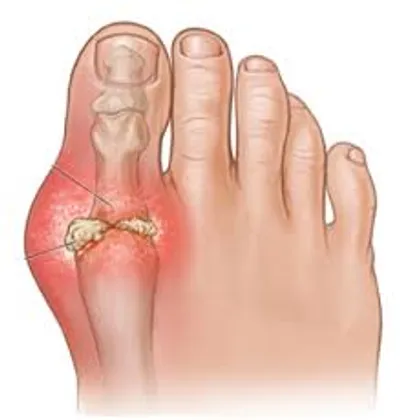 Illustration gout - Image 2