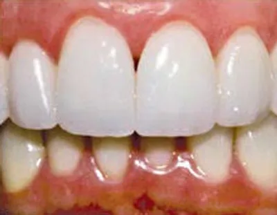 Illustration incisor - Image 2