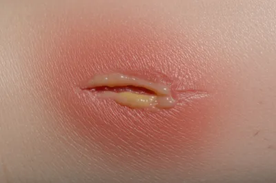 Illustration suppurated