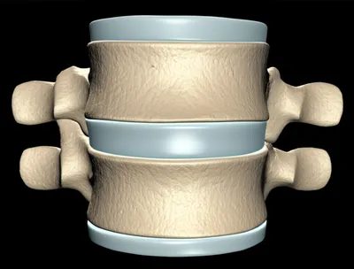 Illustration intervertebral