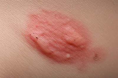 Illustration lesion - Image 1