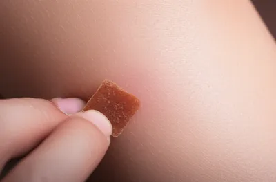 Illustration scabs - Image 1