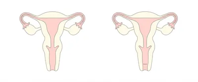 Illustration prolapsus - Image 1