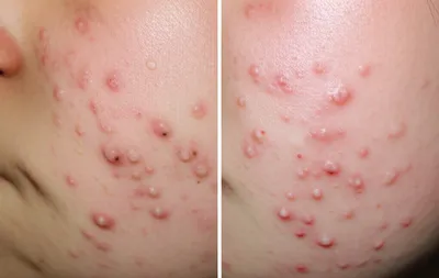 Illustration acne - Image 1