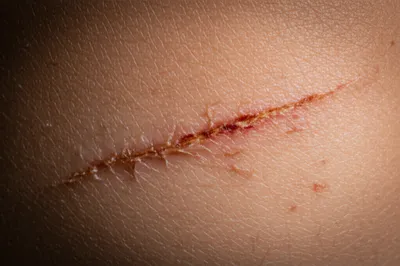 Illustration lesions - Image 1