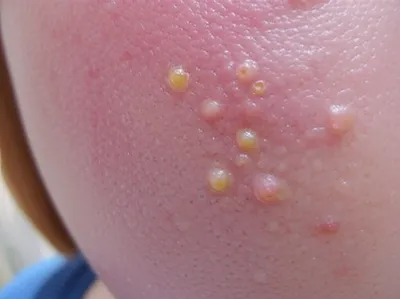 Illustration pimples - Image 1