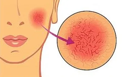 Illustration blotchy - Image 2