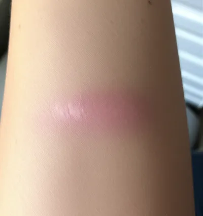 Illustration scarring