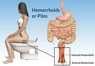 Illustration hemorrhoids - Image 2