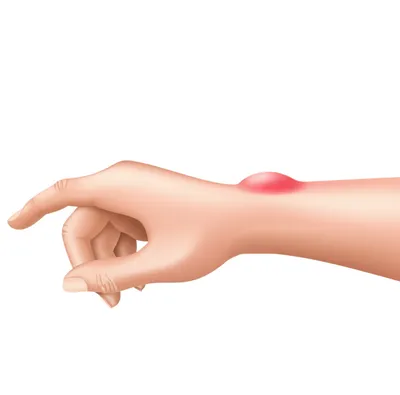 Illustration ganglions - Image 1