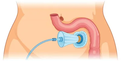 Illustration colostomy