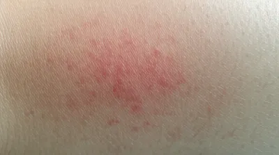 Illustration rash - Image 1