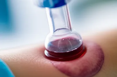 Illustration leech - Image 1