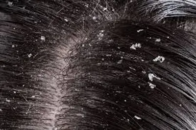 Illustration dandruff - Image 2