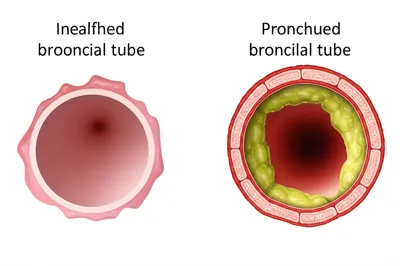 Illustration bronchitis - Image 1