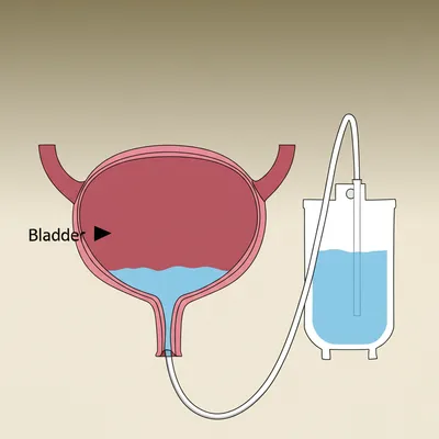 Illustration catheter - Image 1